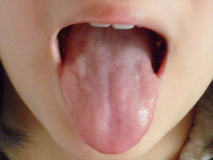 베체트병 재발 막으려면 면역력부터 키워야