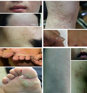 최강 한파, 편평사마귀 물사마귀 환자 급증…