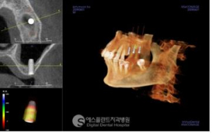 임플란트, CT 정밀검진으로 꼭 필요한 뼈이식만 하세요
