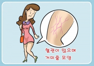 하지정맥류 해답은 휴식과 조기치료