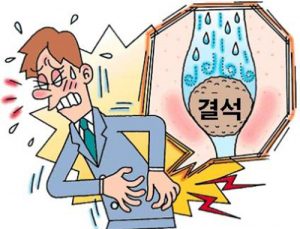 자꾸 옆구리 통증 혹시? 요로결석 질환 의심해야