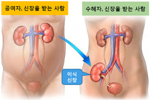 경북대병원 장기이식센터 “국내 최초 혈액형 부적합 신장이식 실현했다”