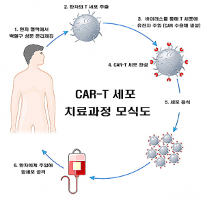 CAR-T치료제, 국내 첫 병원 생산…소아백혈병 무료 치료길 열려