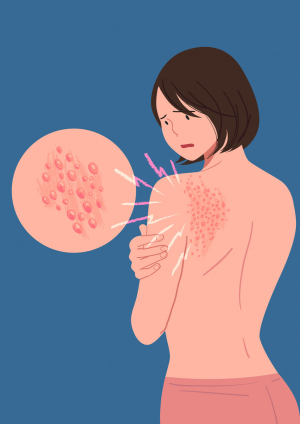 대상포진 예방접종사업무료지원 종료